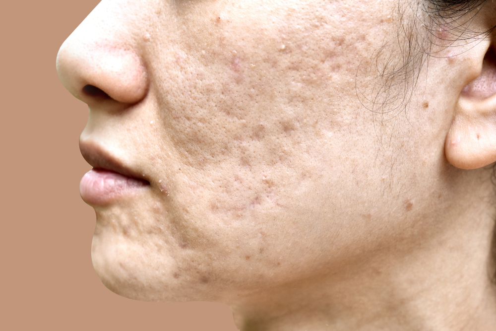 acne scar treatment in hyderabad